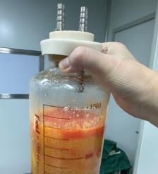 沂南水动力吸脂手术要做多久？